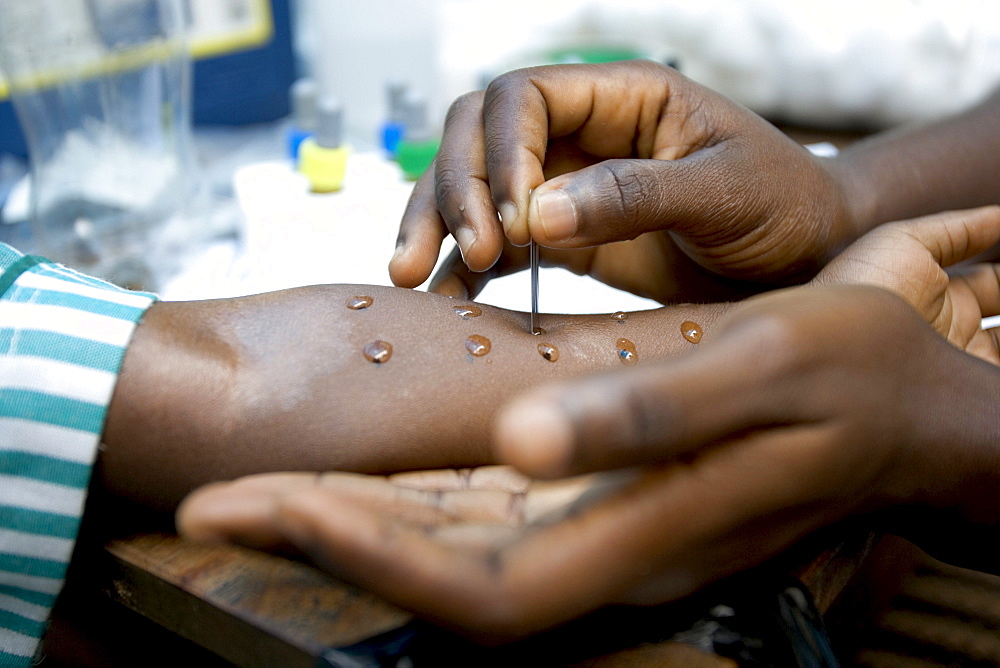 Research assistants and technicians from the University of Ghana perform basic skin prick tests on school children in Accra, Ghana to test for sensitivities to dog, cat, dust mites, grass pollen, peanuts, and cockroach allergens.   The results have shown that children in wealthier homes have higher rates of allergies and asthma than poorer children.  The leading theory is that higher rates of helminth (parasite) infections among poorer children are affecting the immune system in a way that offers protection from allergies and asthma.  The study aims to find out what the worms are doing, isolate the beneficial effect and replicate it.