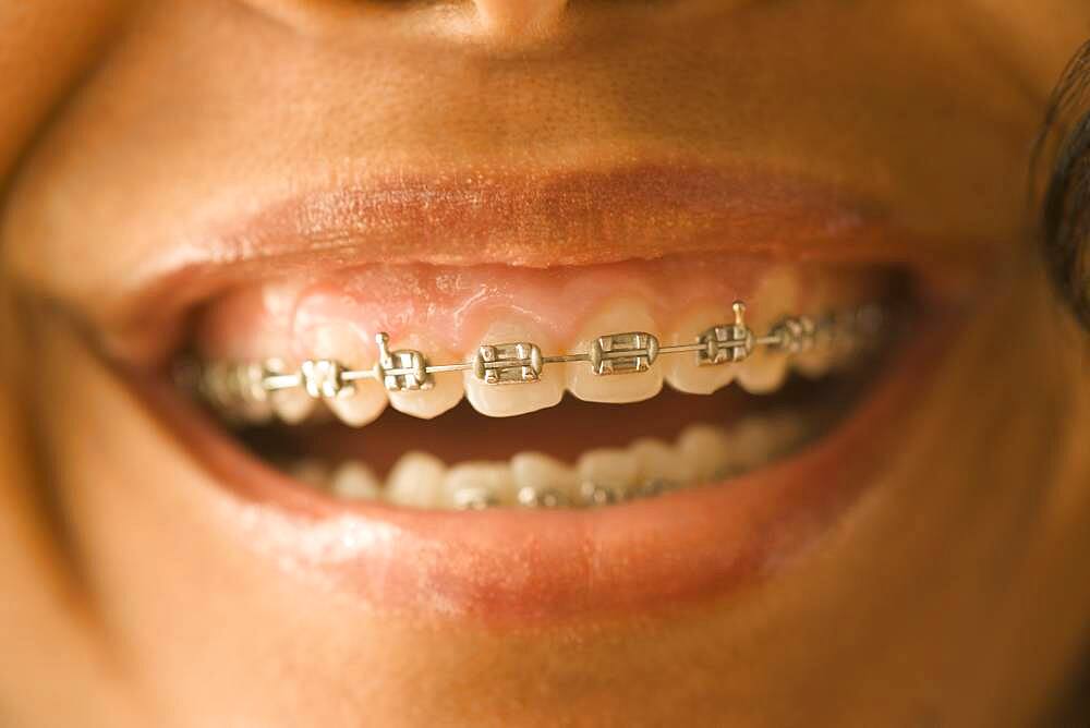 Close up of African woman with orthodontic braces