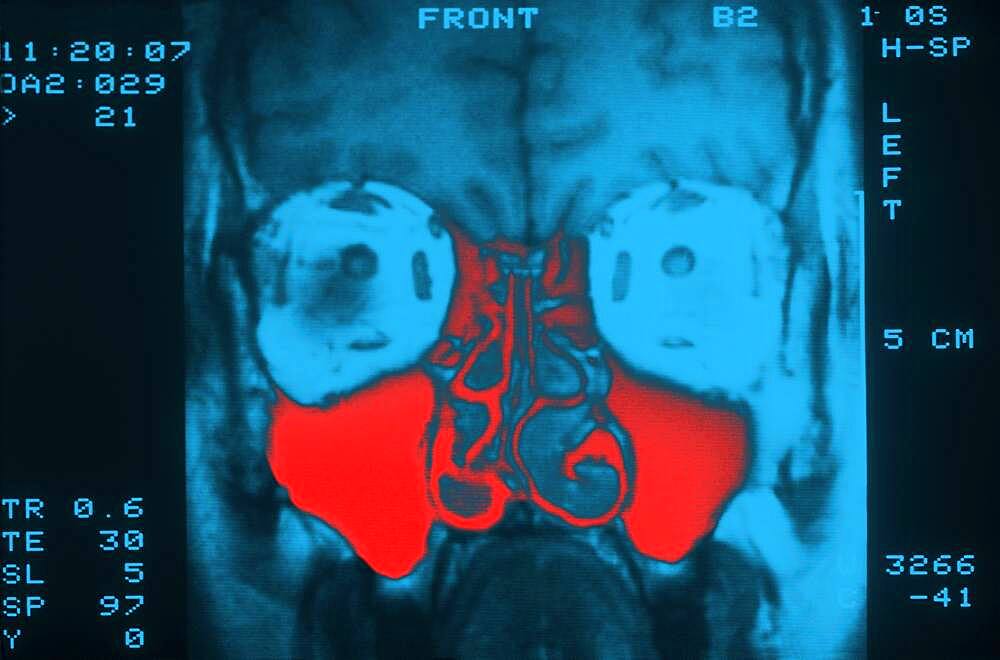 Sinus, mri