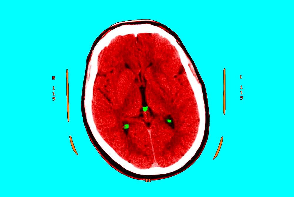 Hyperflash in the two nuclei and particularly the putamen, and the two thalamus.