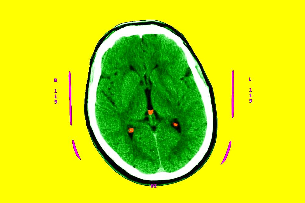 Hyperflash in the two nuclei and particularly the putamen, and the two thalamus.