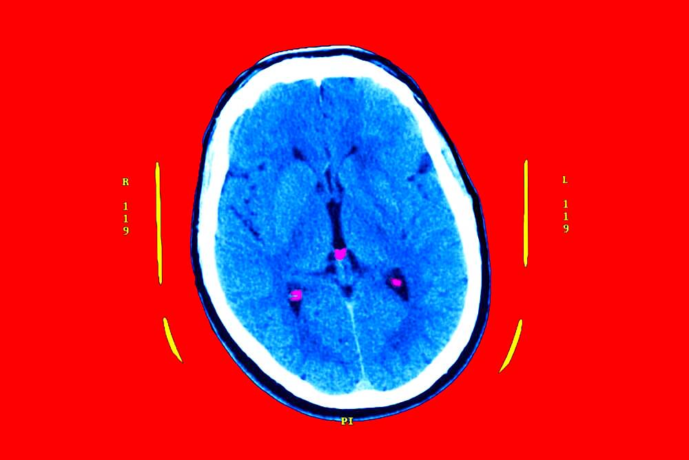 Hyperflash in the two nuclei and particularly the putamen, and the two thalamus.