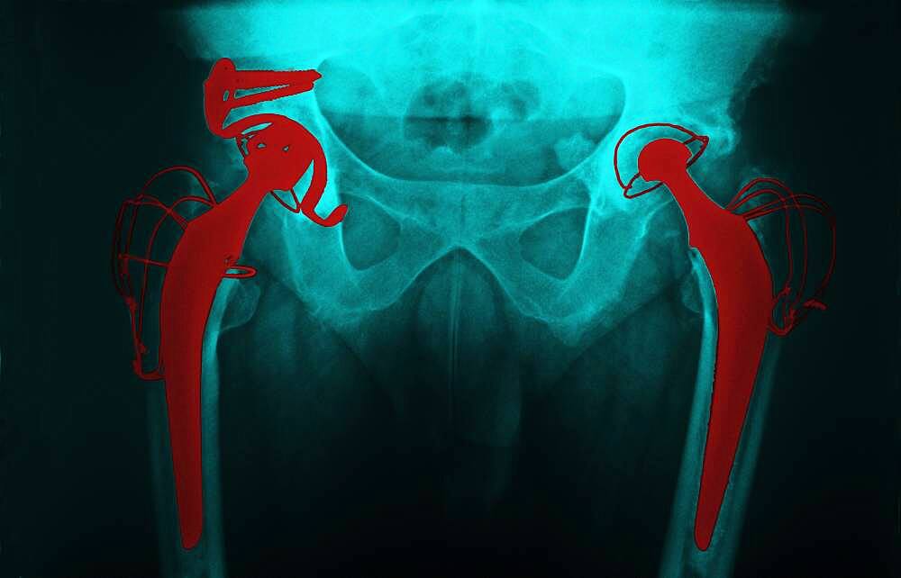 Hip prosthesis, x-ray