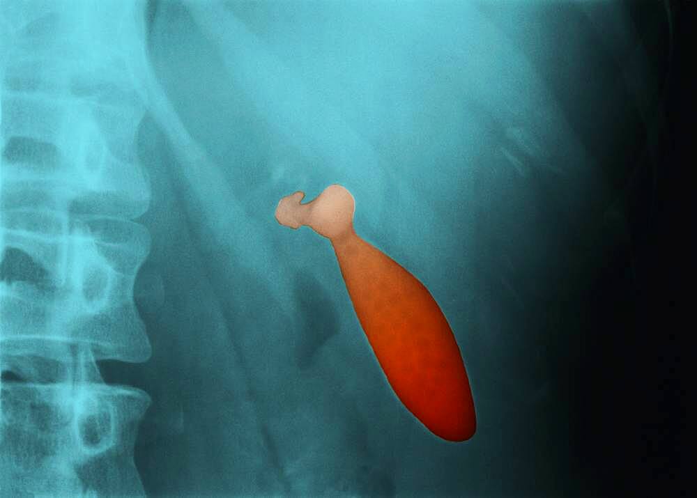 Gallstone, x-ray