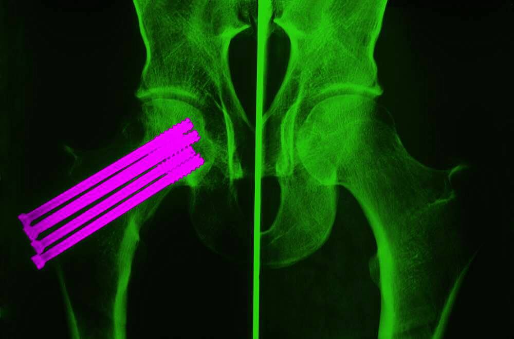 Femur osteosynthesis, x-ray