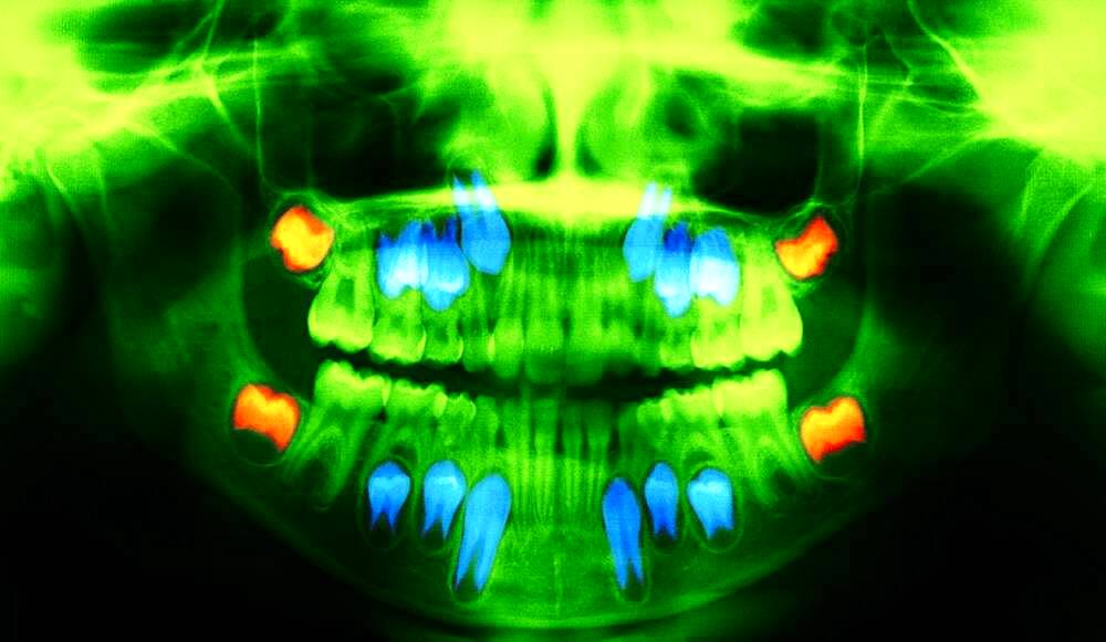 Dental panoramic x-ray. In red, the wisdom teeth ; in blue the permanent teeth that push the baby teeth.