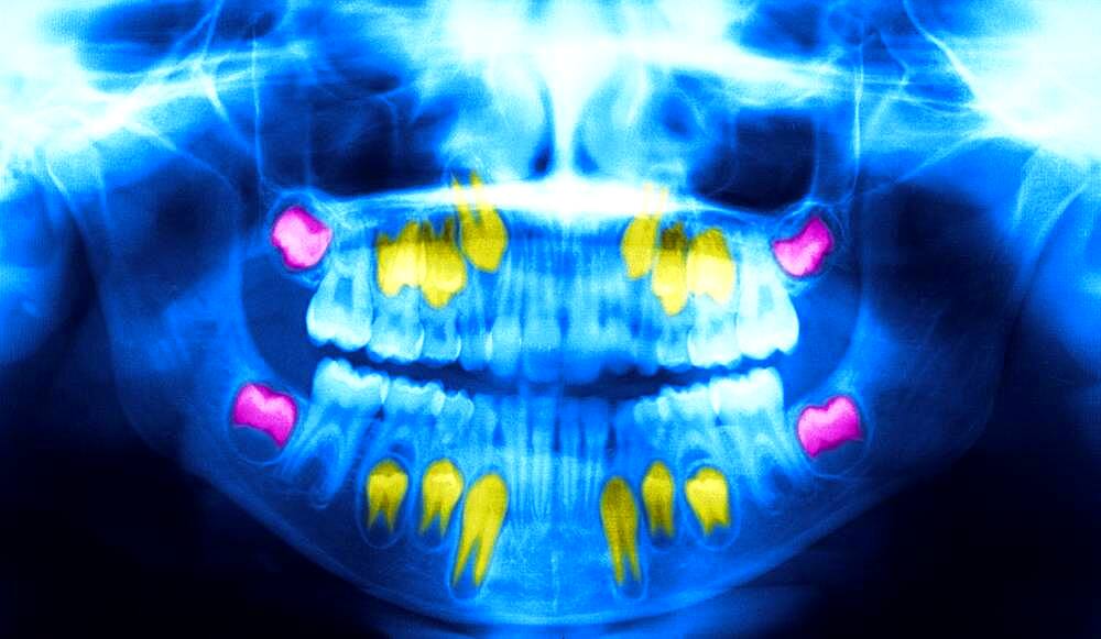 Dental panoramic x-ray. In pink, the wisdom teeth ; in yellow the permanent teeth that push the baby teeth.