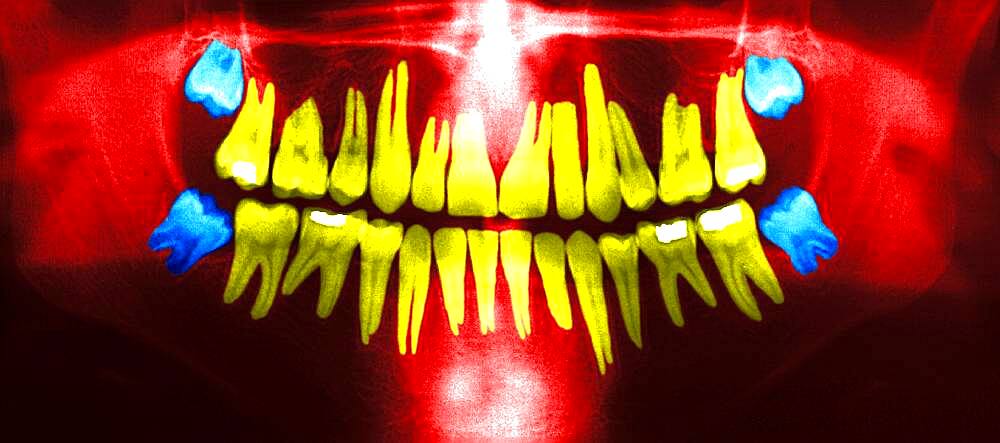 Dental panoramic x-ray. In blue, the wisdom teeth.