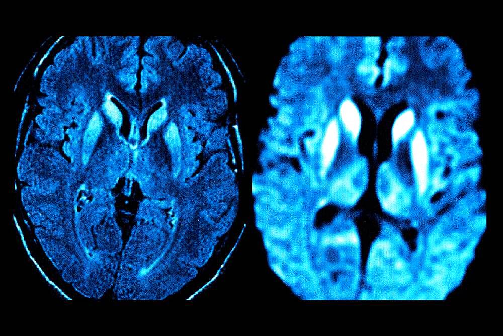 Bilateral lesions of the caudate heads, the putamens, and the internal posterior region of the two thalami (image on the right).