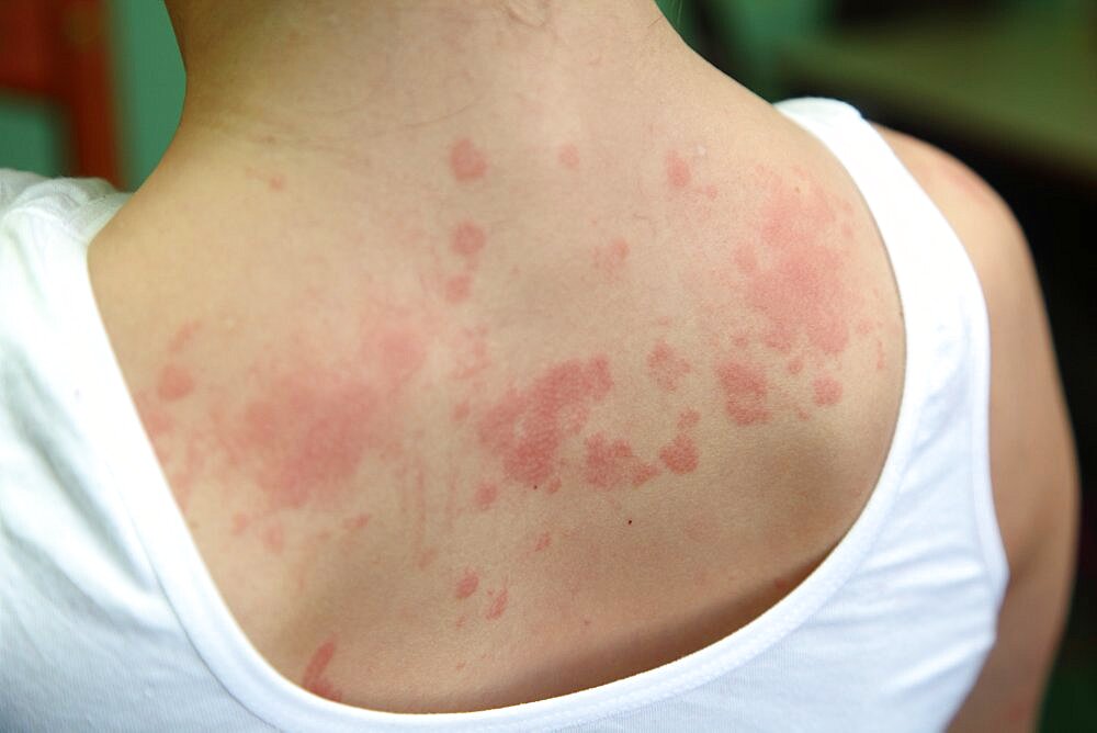 Allergic dermatitis. The skin of the girl's back is amazed by dermatitis.