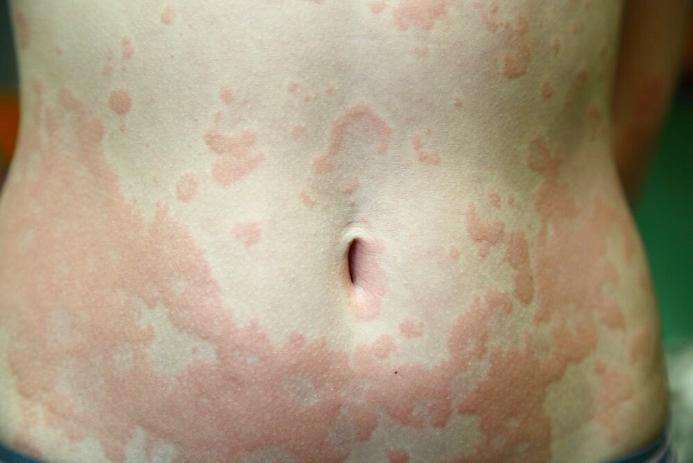 Allergic dermatitis. The skin of the girl is amazed by dermatitis.