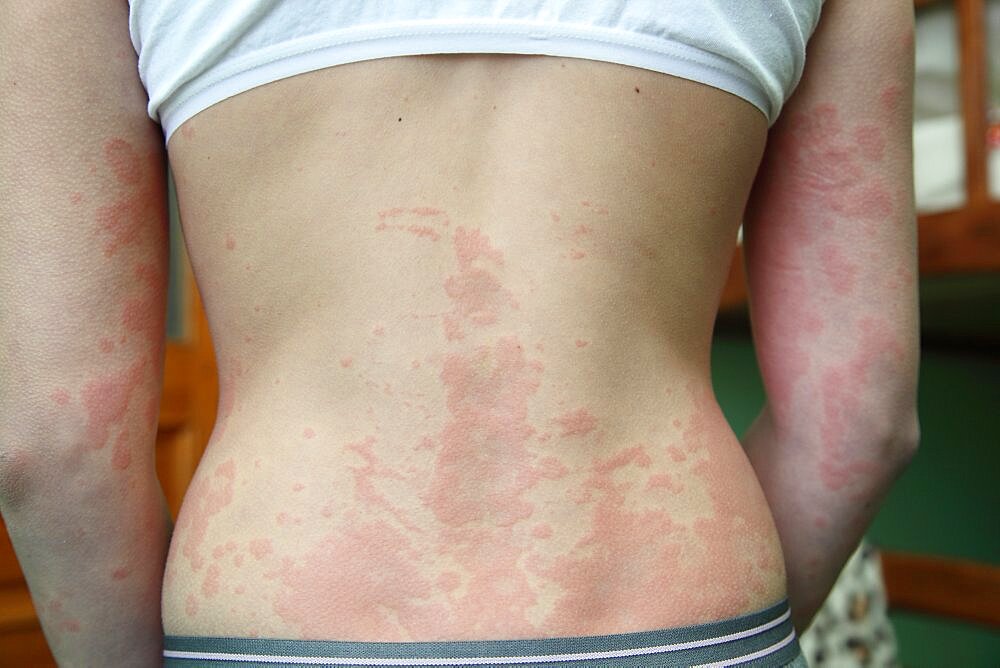 Allergic dermatitis. The skin of the girl's back is amazed by dermatitis.