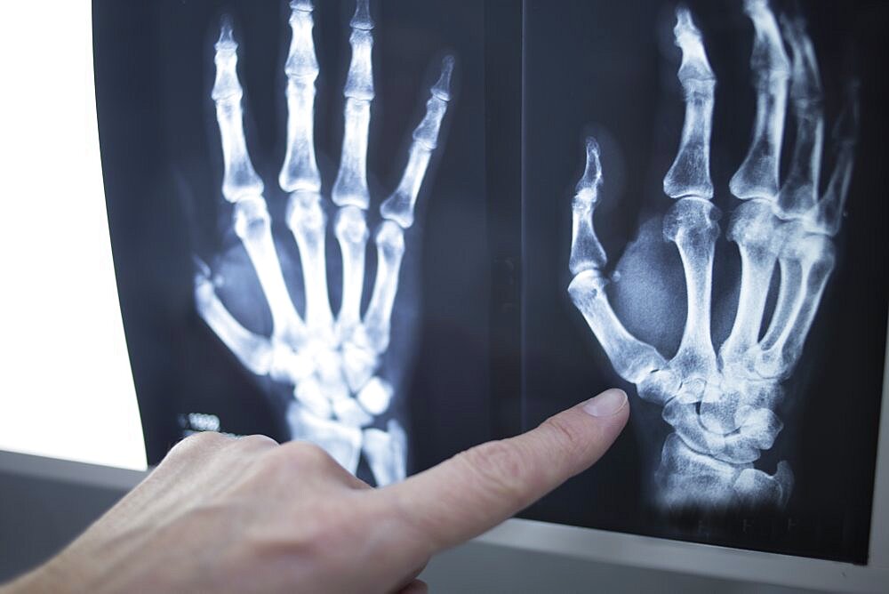 Female medical doctor pointing with finger at radiograph x-ray image on viewing light screen monitor showing hand of patient in scan.