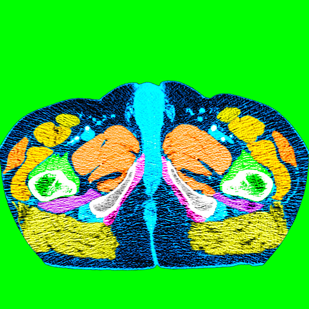 Scanner of a man pelvis and perineum