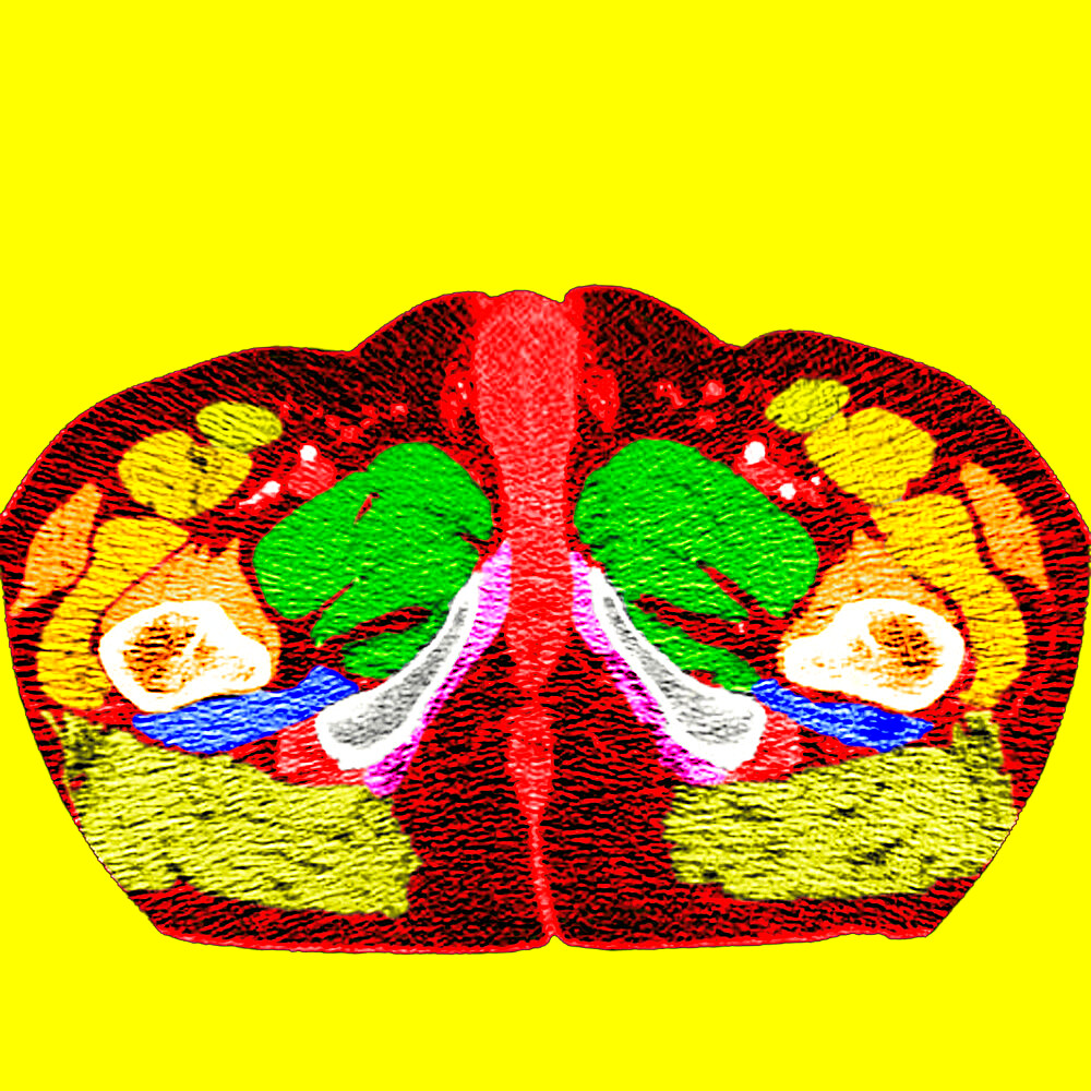 Scanner of a man pelvis and perineum