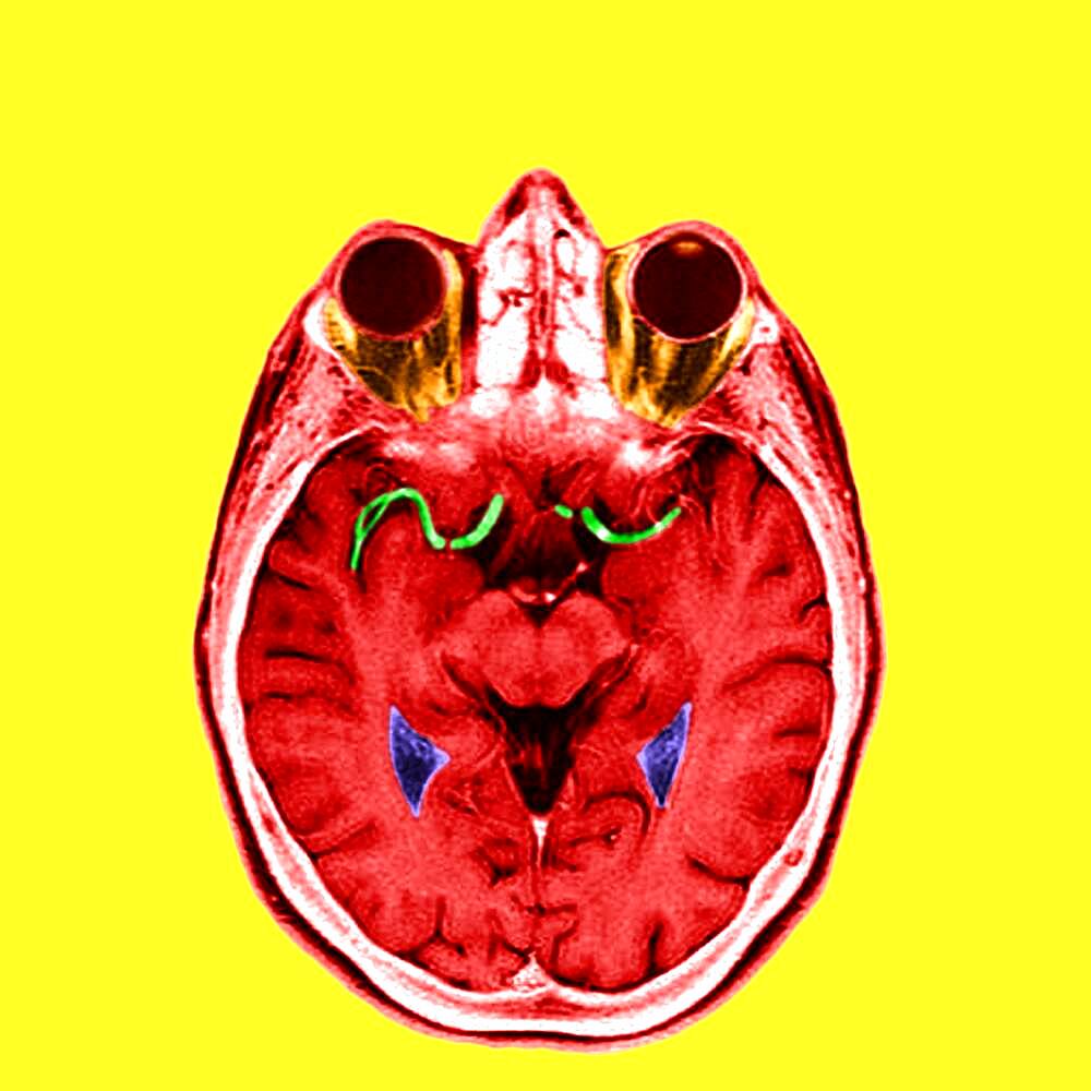 Highlight of the anterior and medium cerebral arteries.