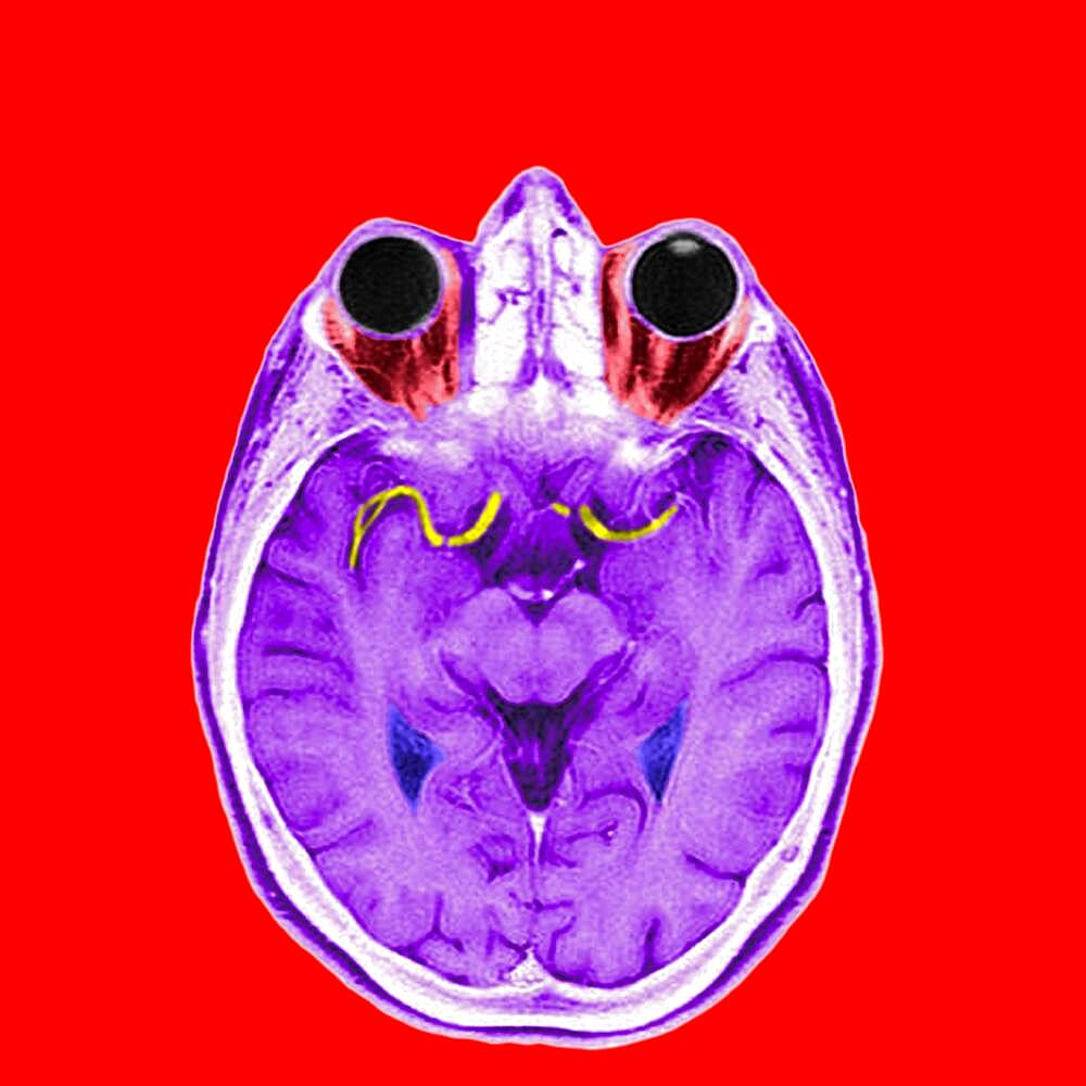 Highlight of the anterior and medium cerebral arteries.