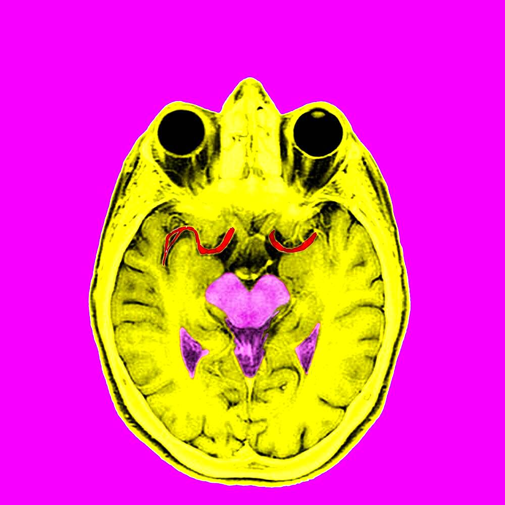 Highlight of the anterior and medium cerebral arteries.