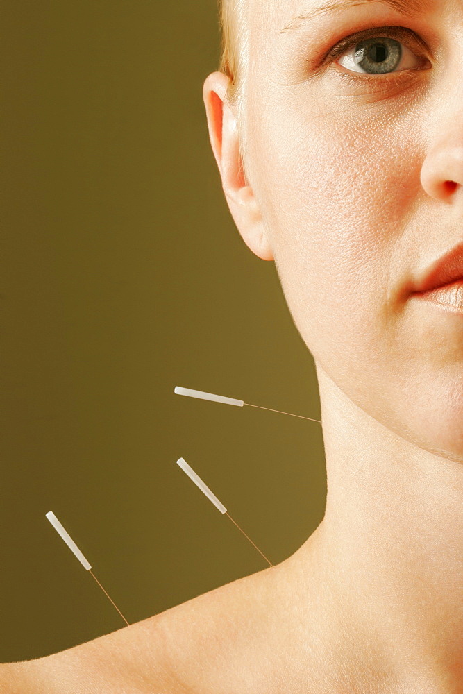 Women Receiving Acupuncture Treatment