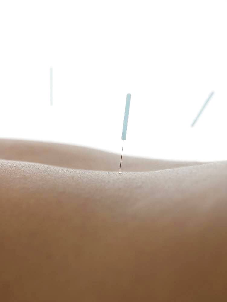 Close up of acupuncture needles in back of woman