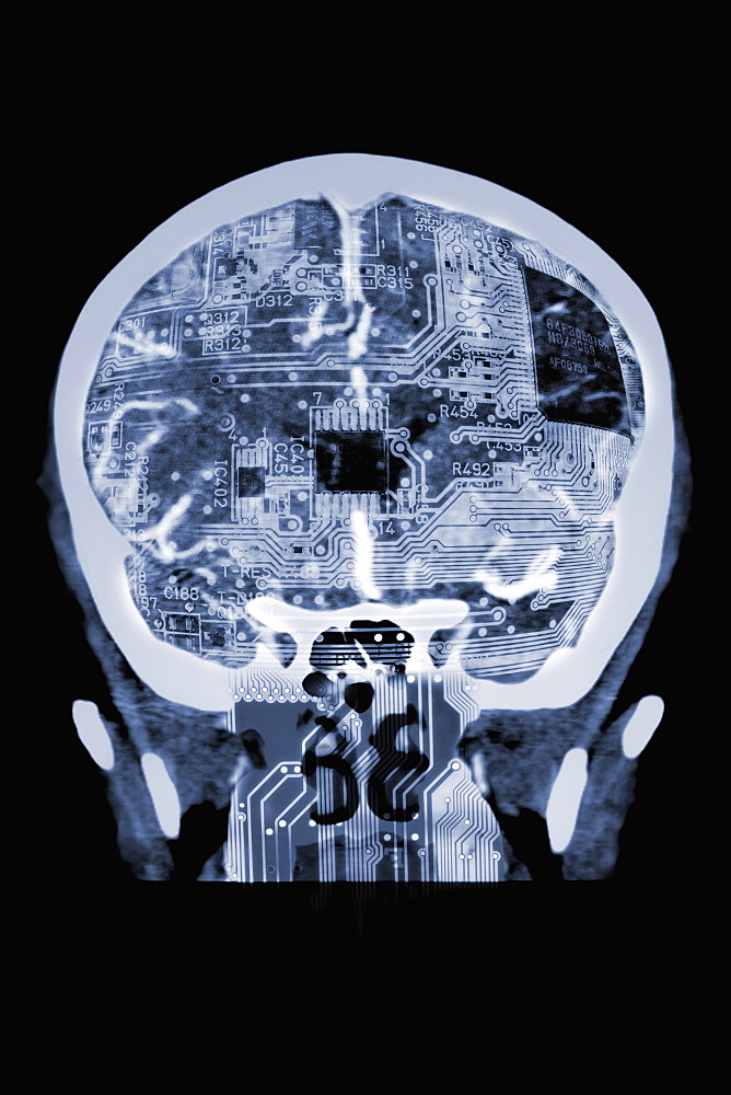 Circuit board in x-ray of skull