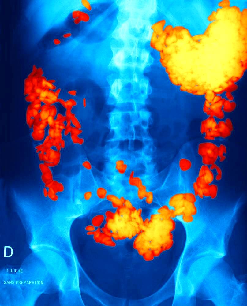 Gastric pains. Stomach of a patient having swallowed pebbles.