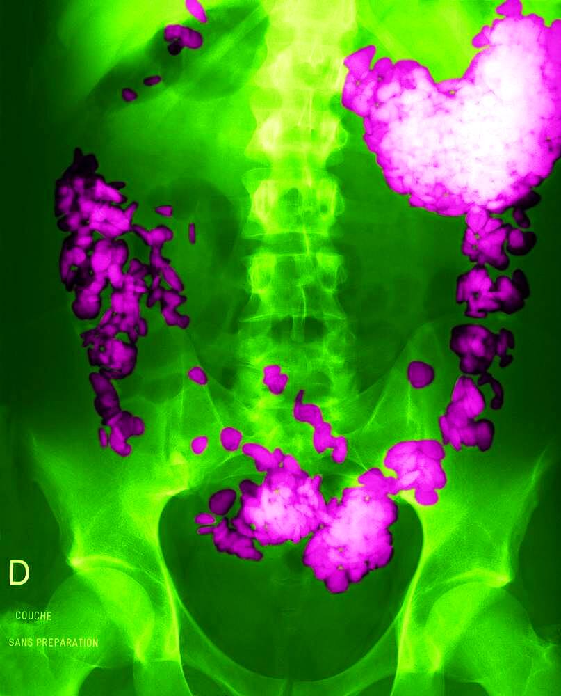 Gastric pains. Stomach of a patient having swallowed pebbles.