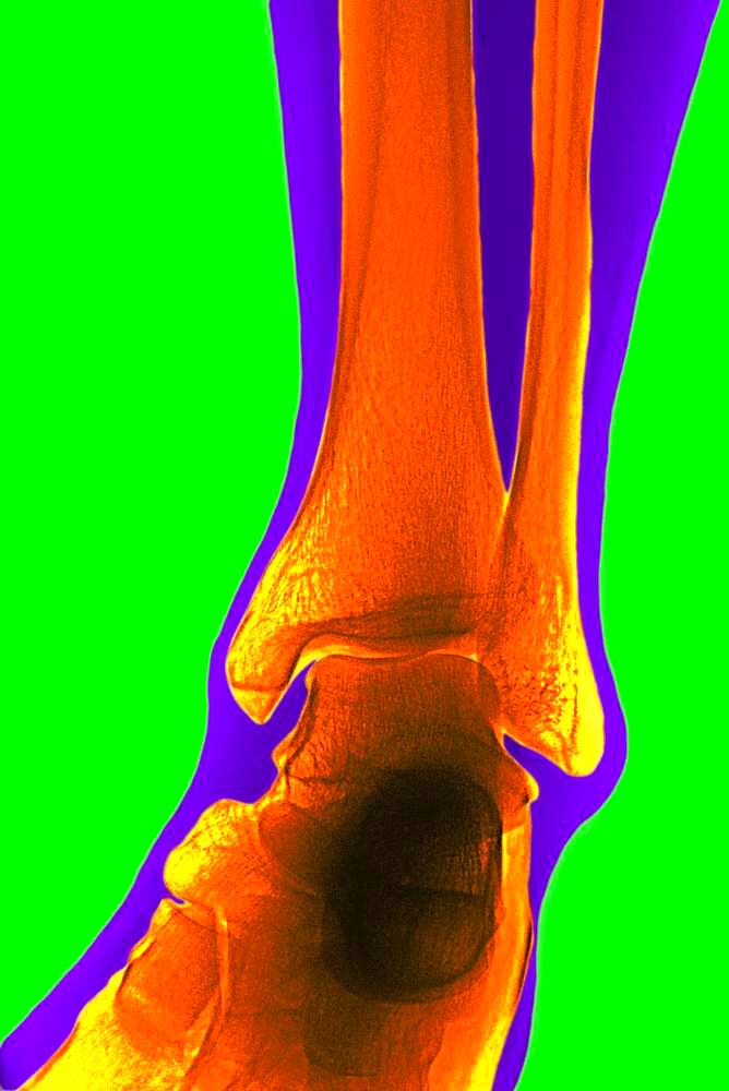 Ankle, x-ray