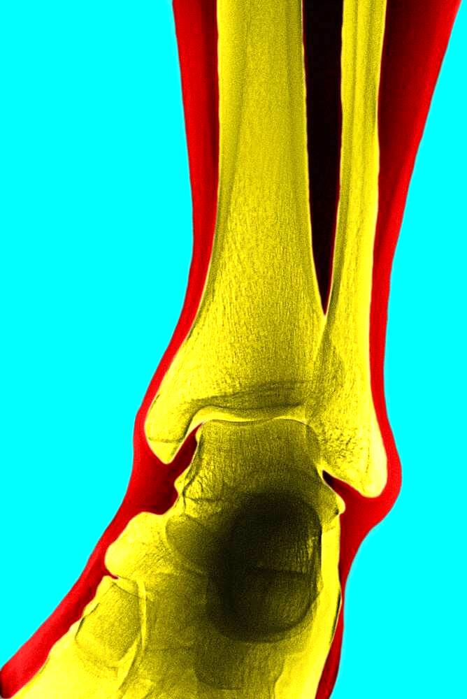 Ankle, x-ray