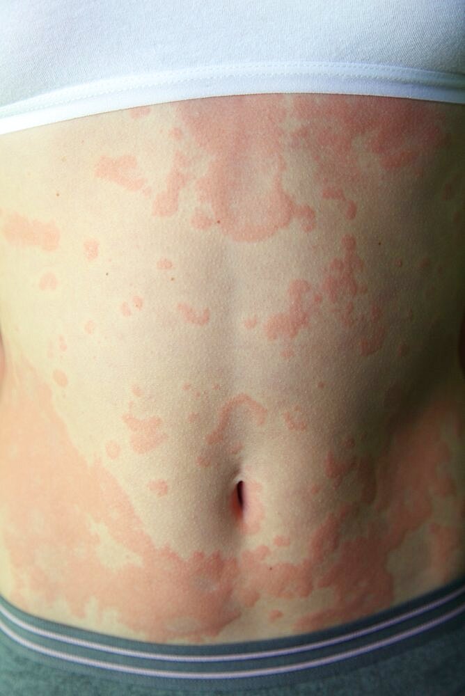 Allergic dermatitis. The skin of the girl is amazed by dermatitis.