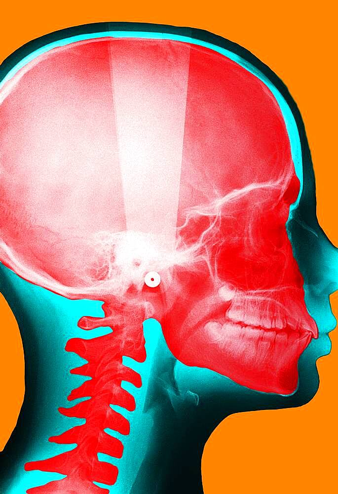 X-ray of the skull.