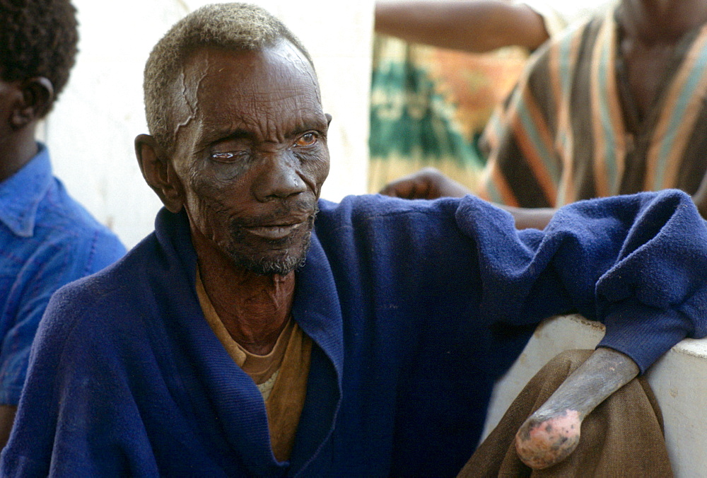 Patient suffering from leprosy attending a clinic in The Gambia