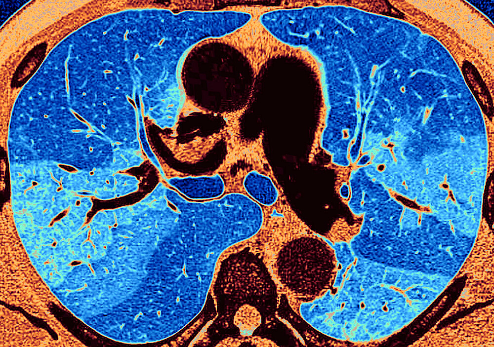 Pulmonary fibrosis (lesion of the lungs characterized by the presence of excess fibrous connective tissue), chest scanner