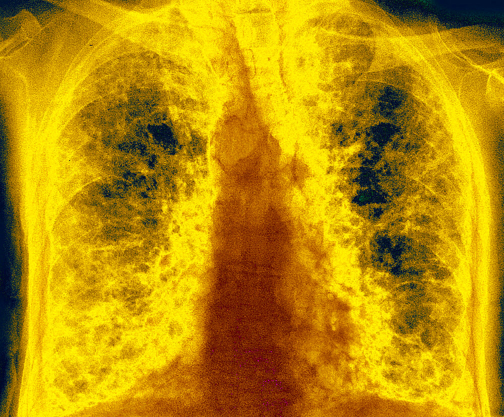 Pulmonary fibrosis