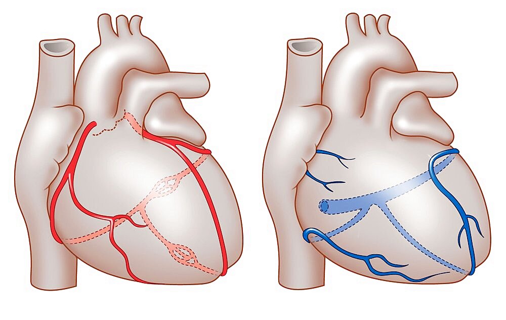 Coronary, Drawing