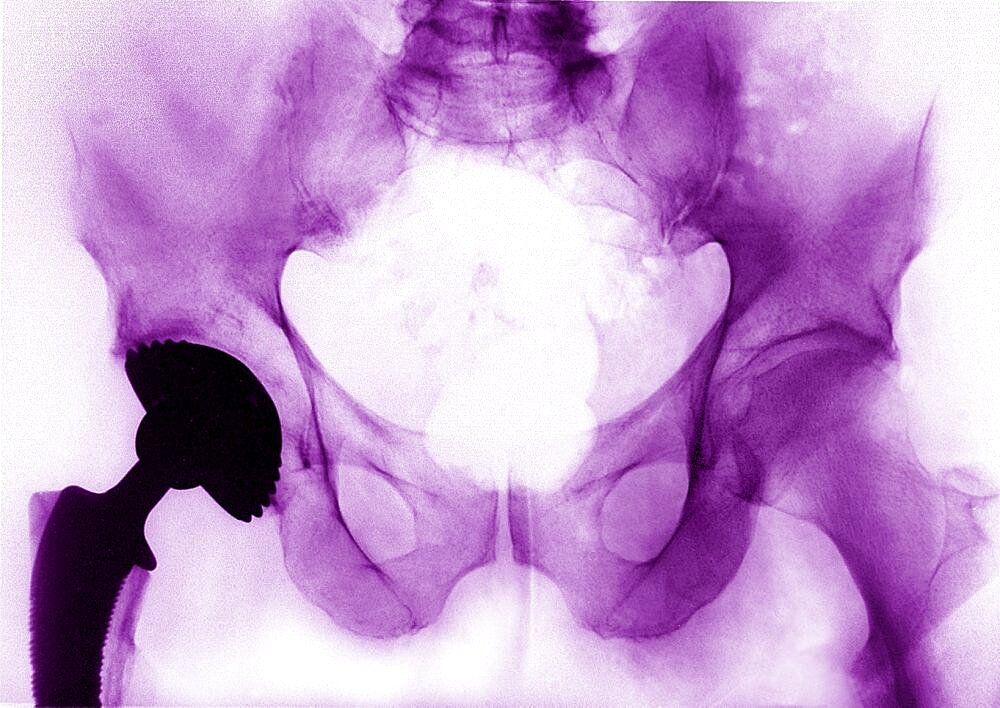 Hip Prosthesis,  X-Ray