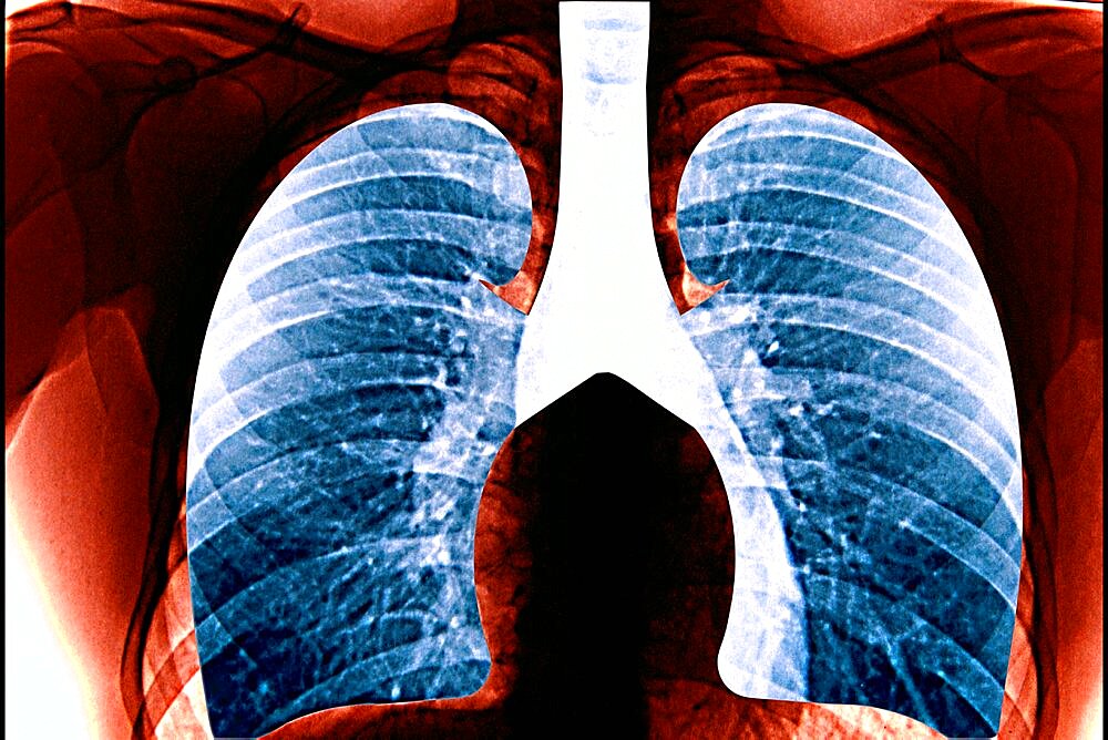 Lung, X-Ray Result