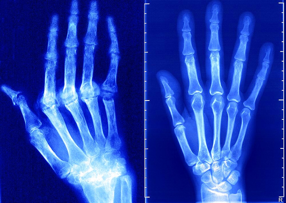 Rheumatoid Arthritis, X-Ray