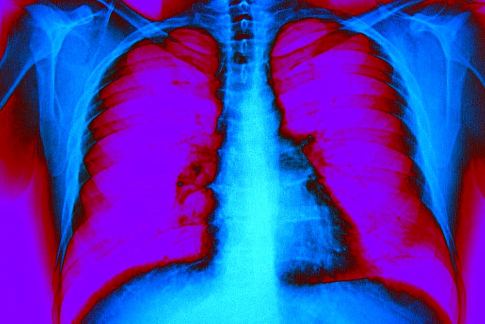 Lung, X-Ray Result