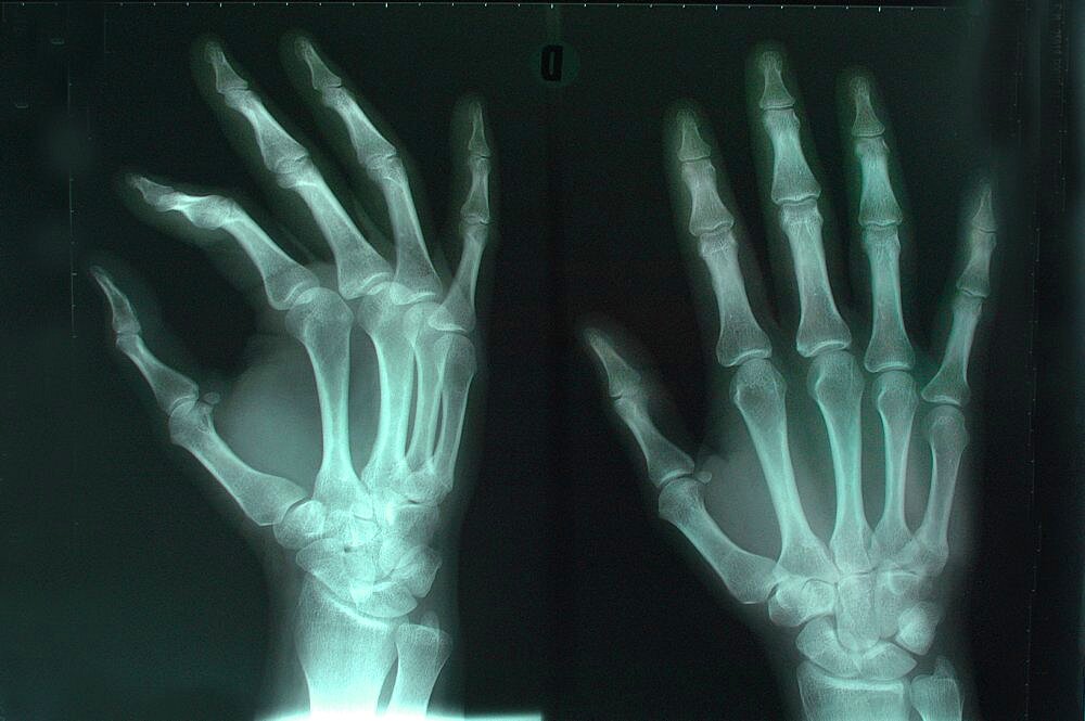 Hand, X-Ray