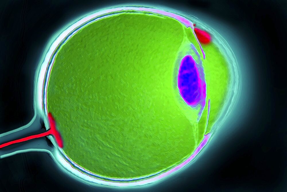 Glaucoma
