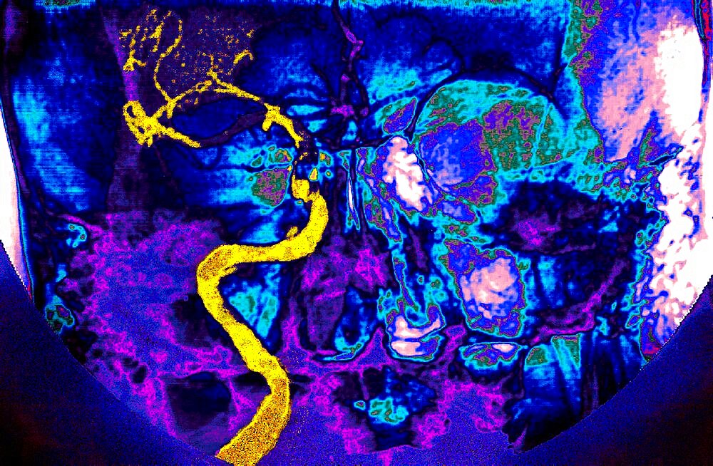 Carotid, Angiography