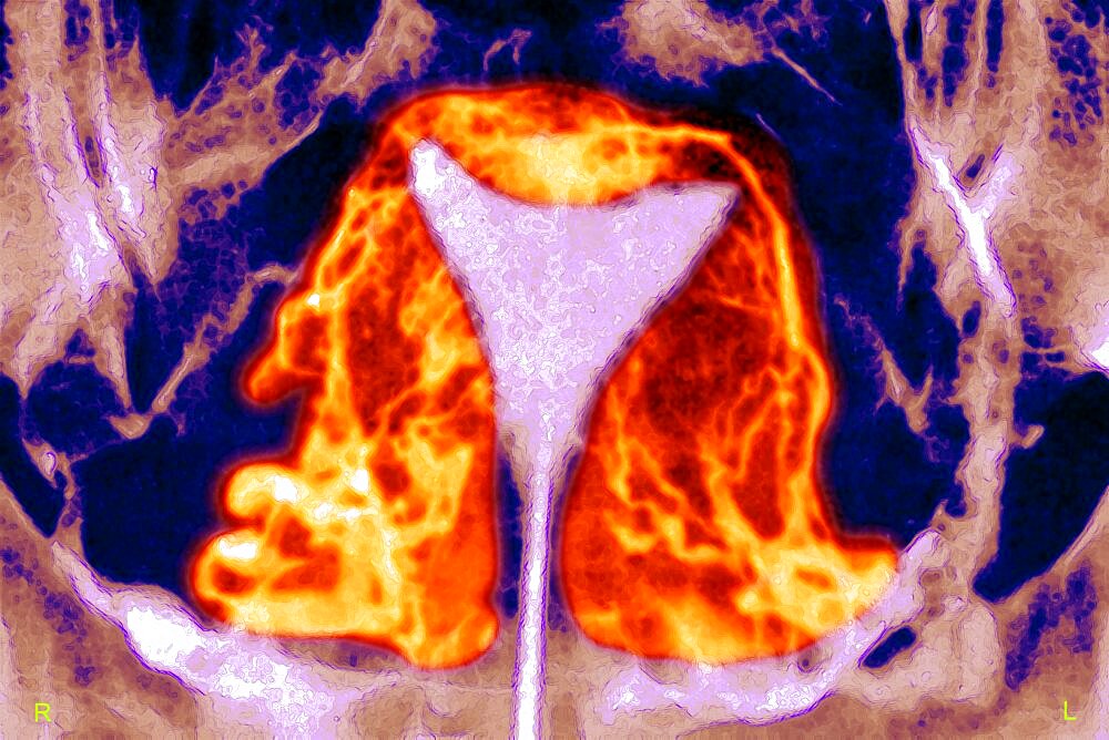 Uterus, Angiography