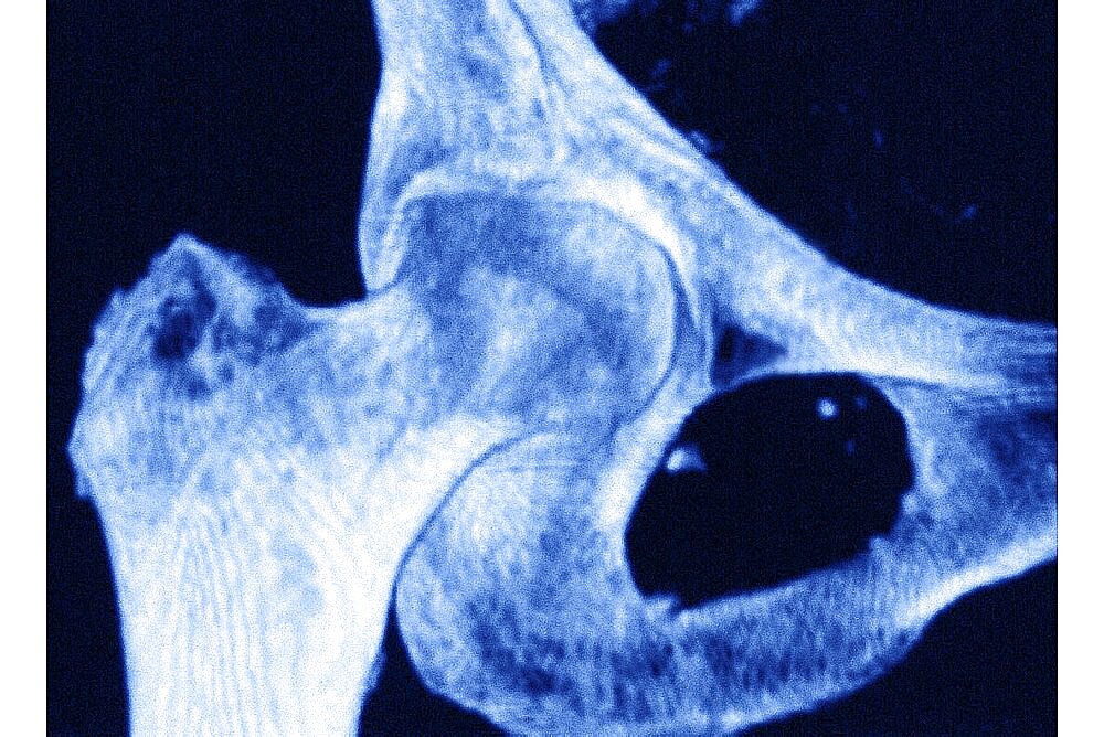 Tridimensionnal MRI Of A Right Hip