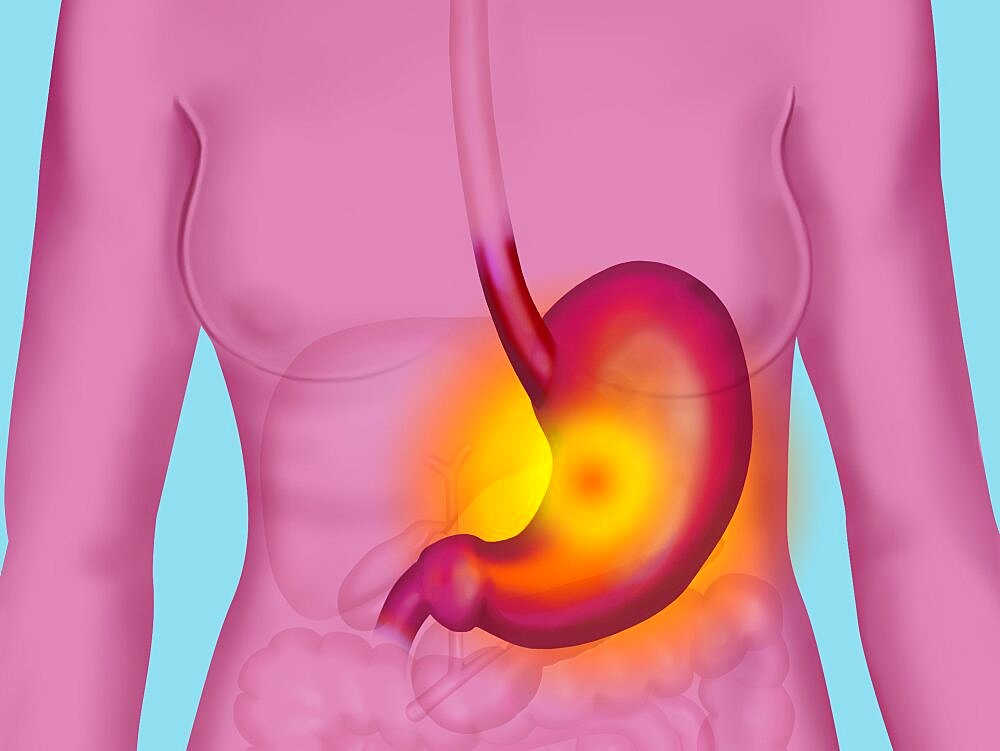 Gastric Ulcer, Illustration