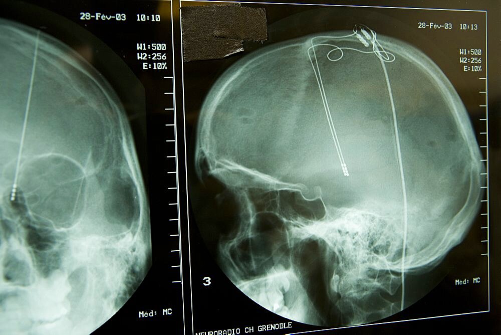 Brain Electrostimulation, X-Ray