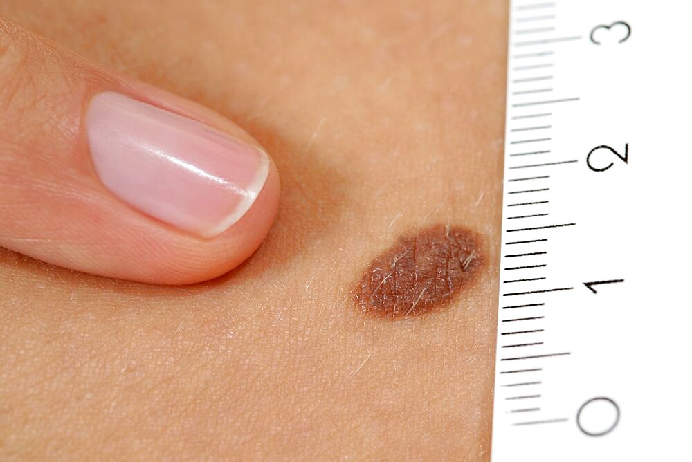 Measuring Nevus on Skin