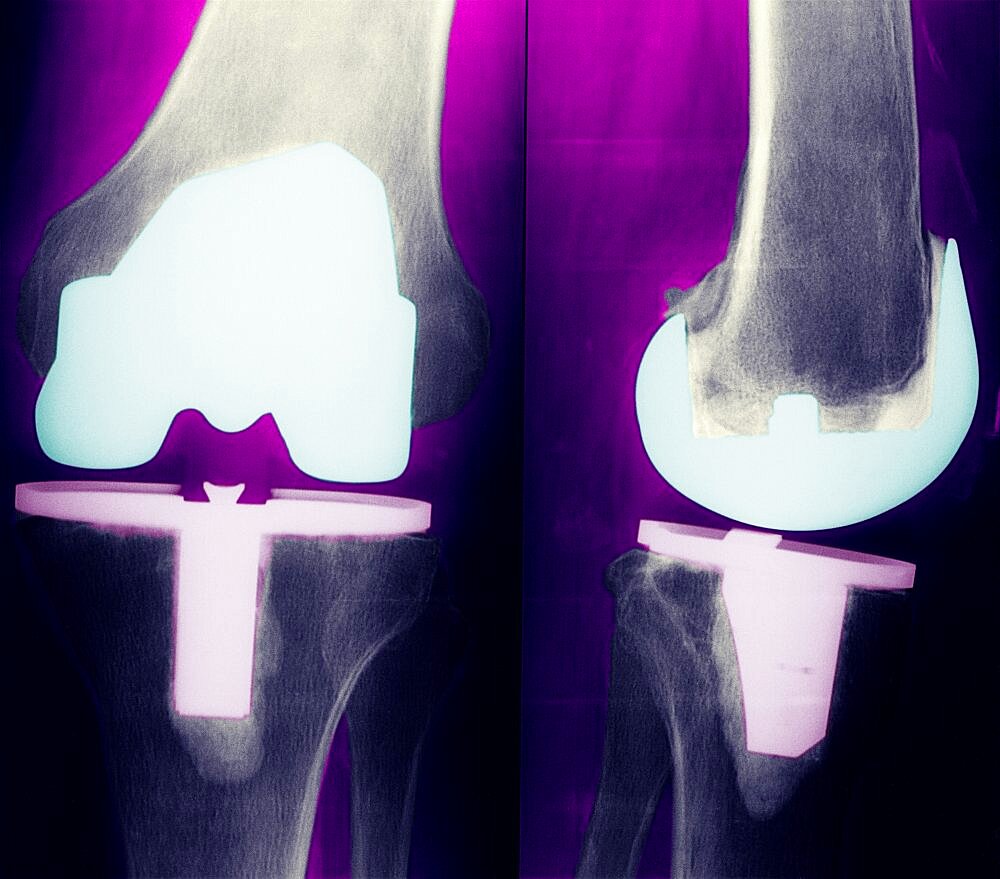 Knee Prosthesis,  X-Ray