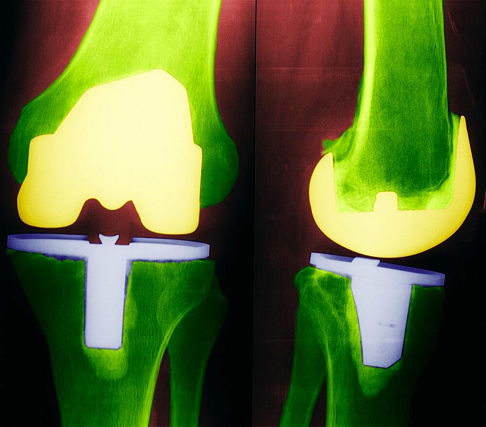 Knee Prosthesis,  X-Ray