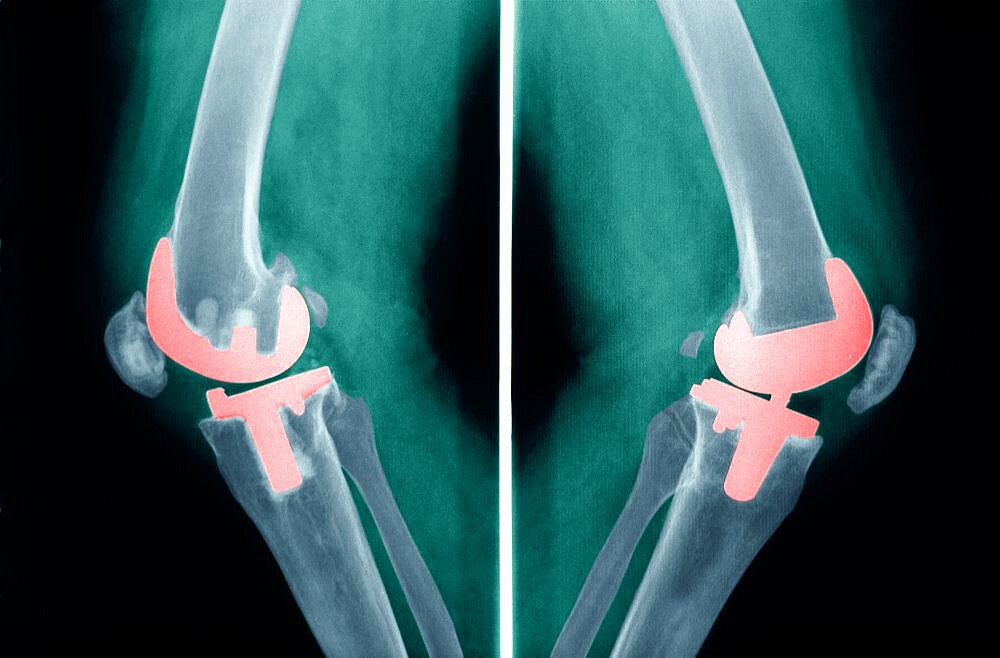 Knee Prosthesis, X-Ray